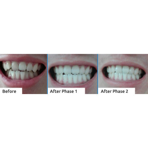 Secret Smile™ - Teeth Aligner | Set 1.0 - Secret Smile Co