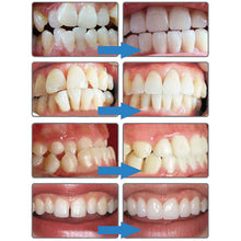 Load image into Gallery viewer, Secret Smile™ - Teeth Aligner | Set 1.0 - Secret Smile Co
